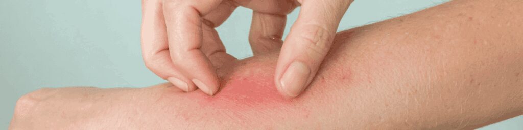 Exemple d'irritation cutanée, précaution à prendre lors de l'utilisation de géraniol pur.