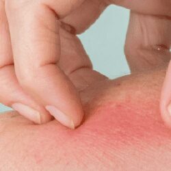 Piqûre de guêpe sur la peau, montrant l'importance de la lutte contre ces insectes nuisibles.